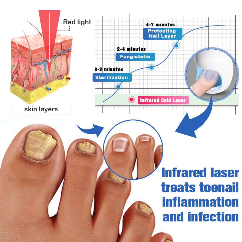 Furzero™ Gwóźdź Grzybica Laser czyszczący Urządzenie odciążające